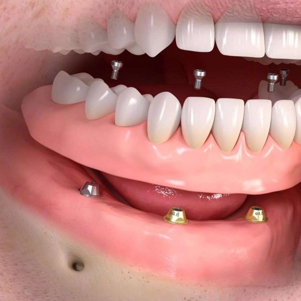 методы лечения - когда отсутствуют все зубы