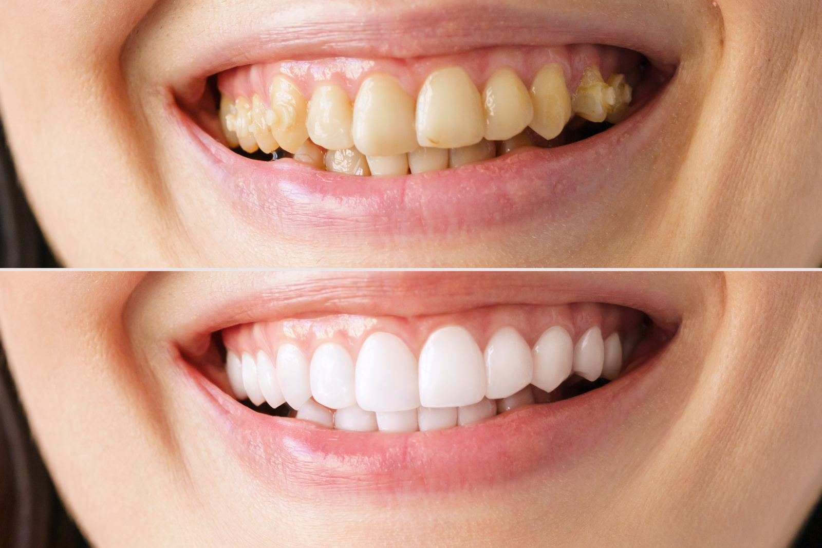Как выровнять зубы без брекетов? Метод художественной реставрации