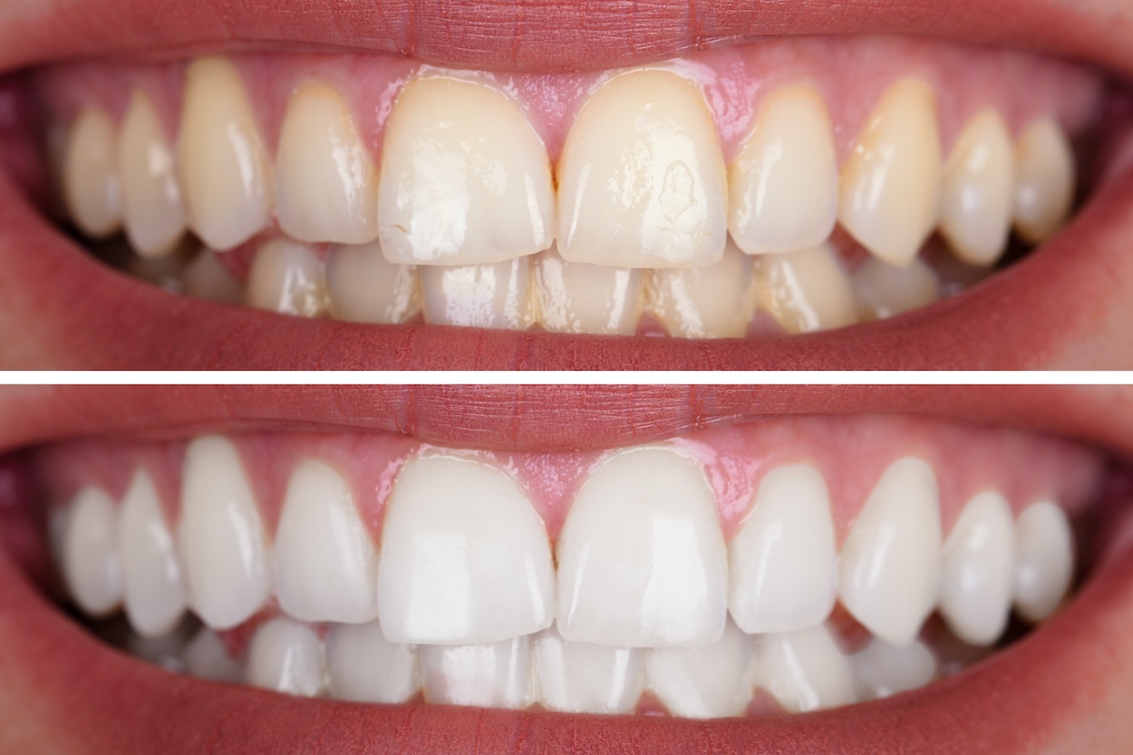 centra-dental-teeth-white.jpg