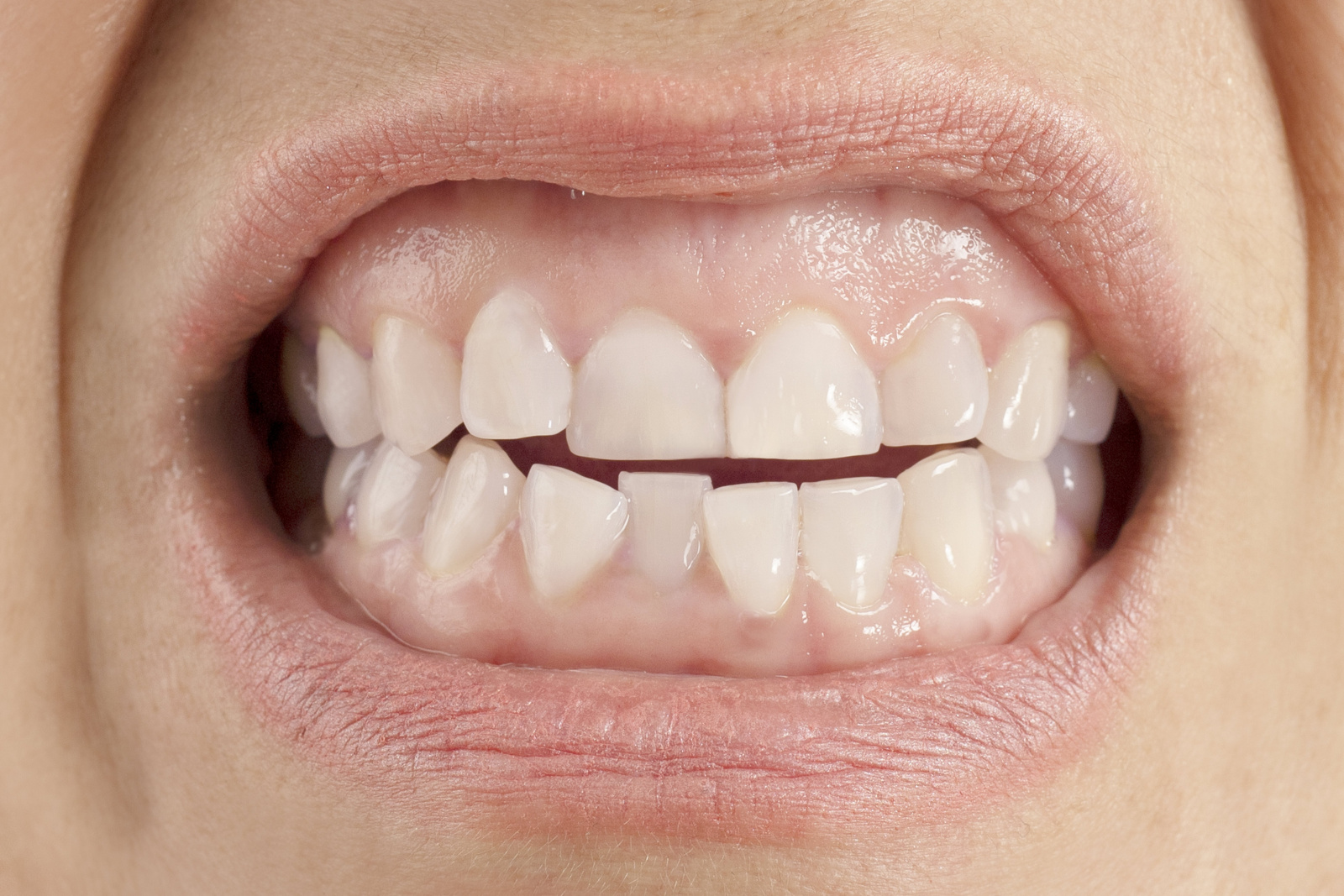 Методы выравнивания зубов и исправления прикуса