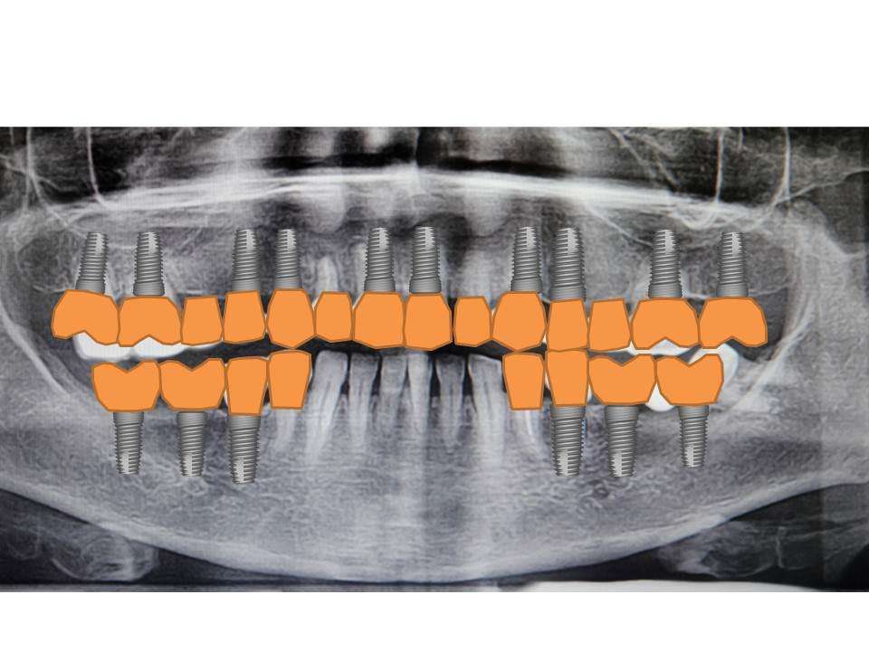 до имплантации зубов 1