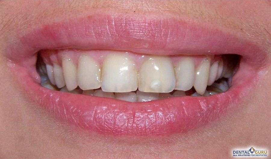 композитное отбеливание зубов 1 - 1
