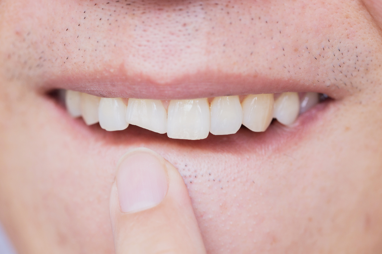 бруксизм: откололся зуб
