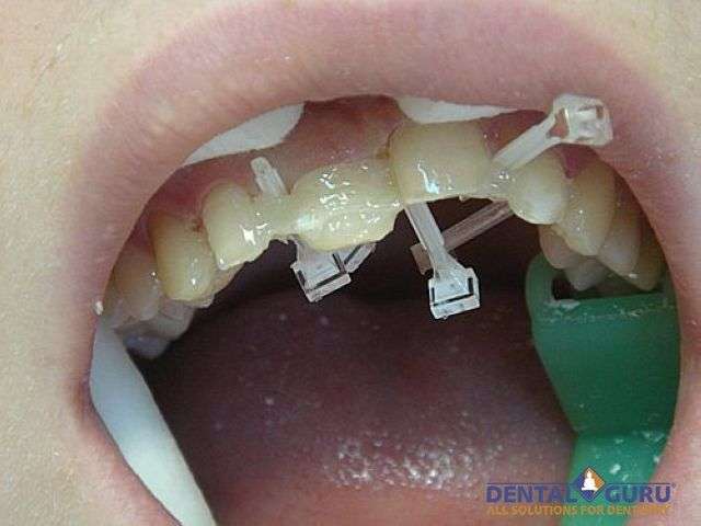 Выровнять зубы - методы выравнивания зубов