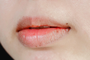 Хейлит - болезнь губ. Причины, симптомы, лечение