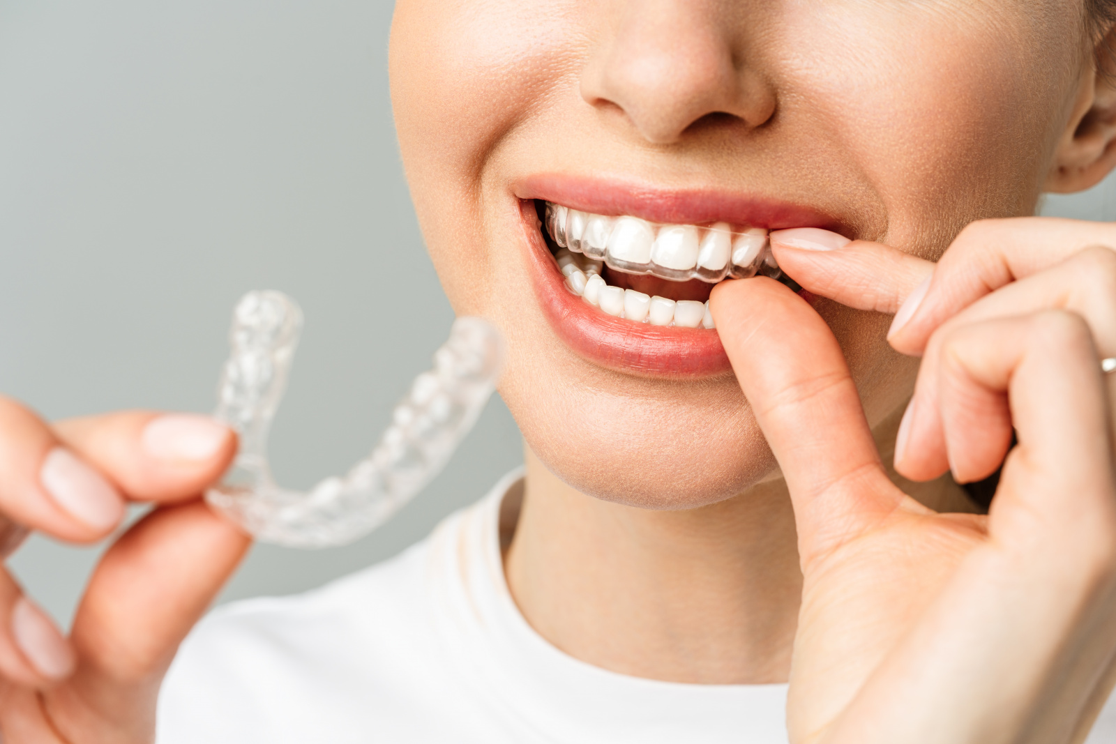 Как выровнять зубы без брекетов? Ортодонтические пластины