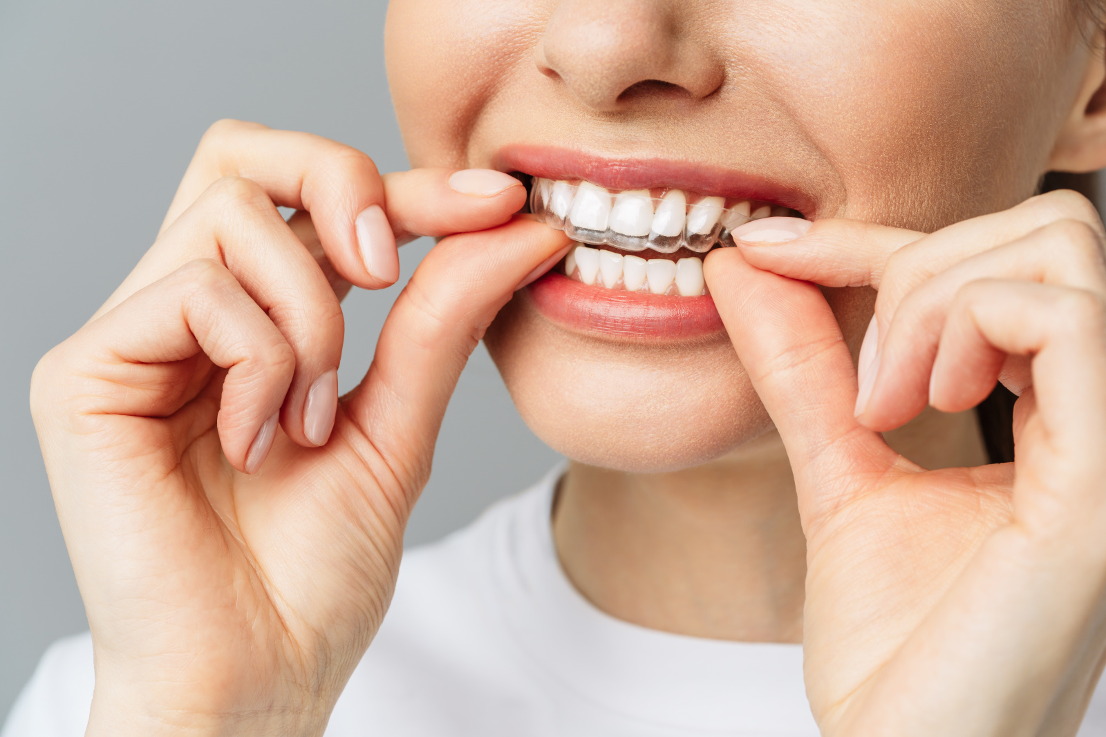 Как выровнять зубы без брекетов?Элайнеры