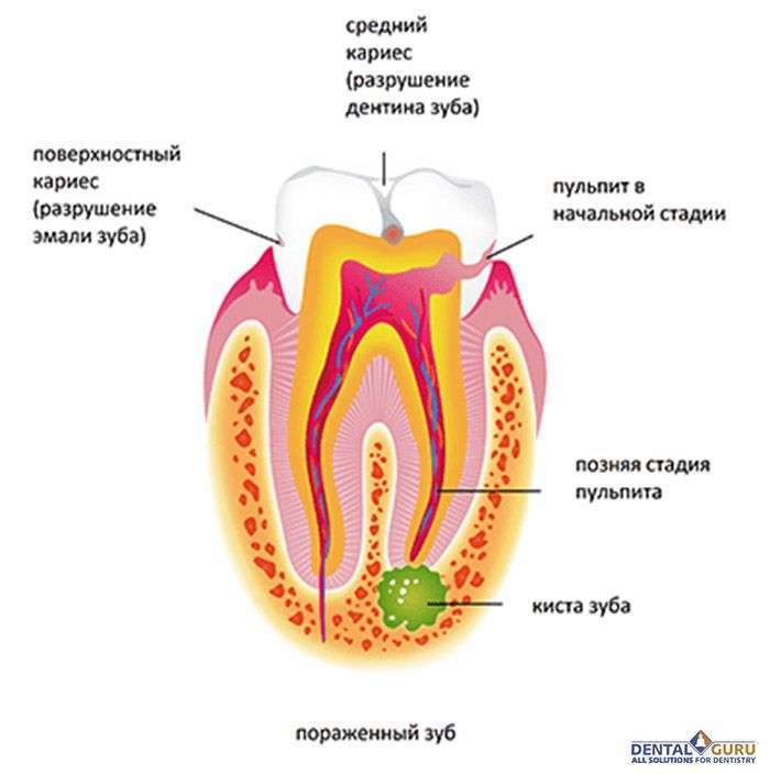 Температура после лечения зуба. Корневая (радикулярная) киста. Корневая гранулема зуба.