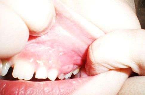 Возможные причины образования шишки во рту