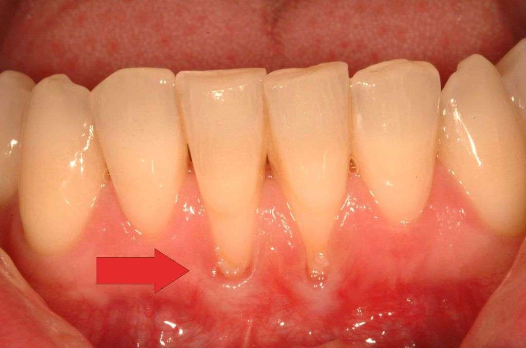 Причины оголения шейки зуба