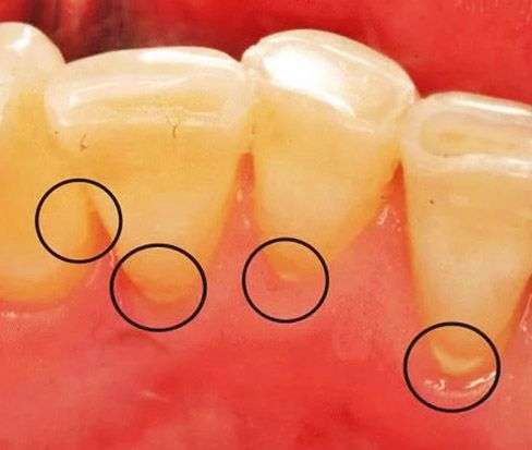 Почему образуется зубной камень?