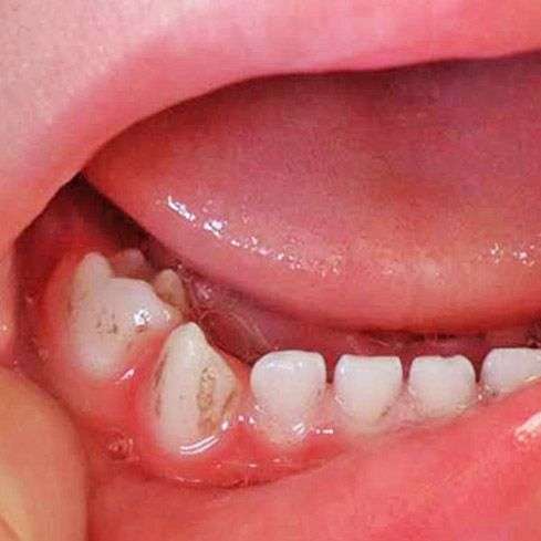 Черный налет на зубах: как удалить