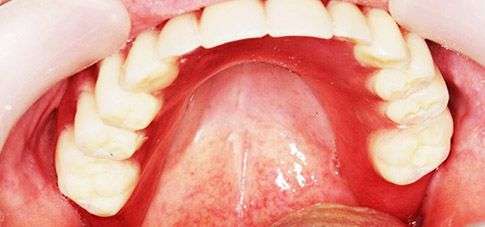 Воспаление нёба во рту: как лечить и предупредить его повторения?