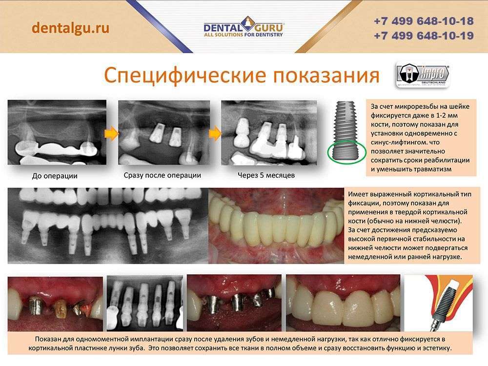 Зубы импланты поэтапно. Этапы имплантации зубов. Имплантация зубов по этапам.