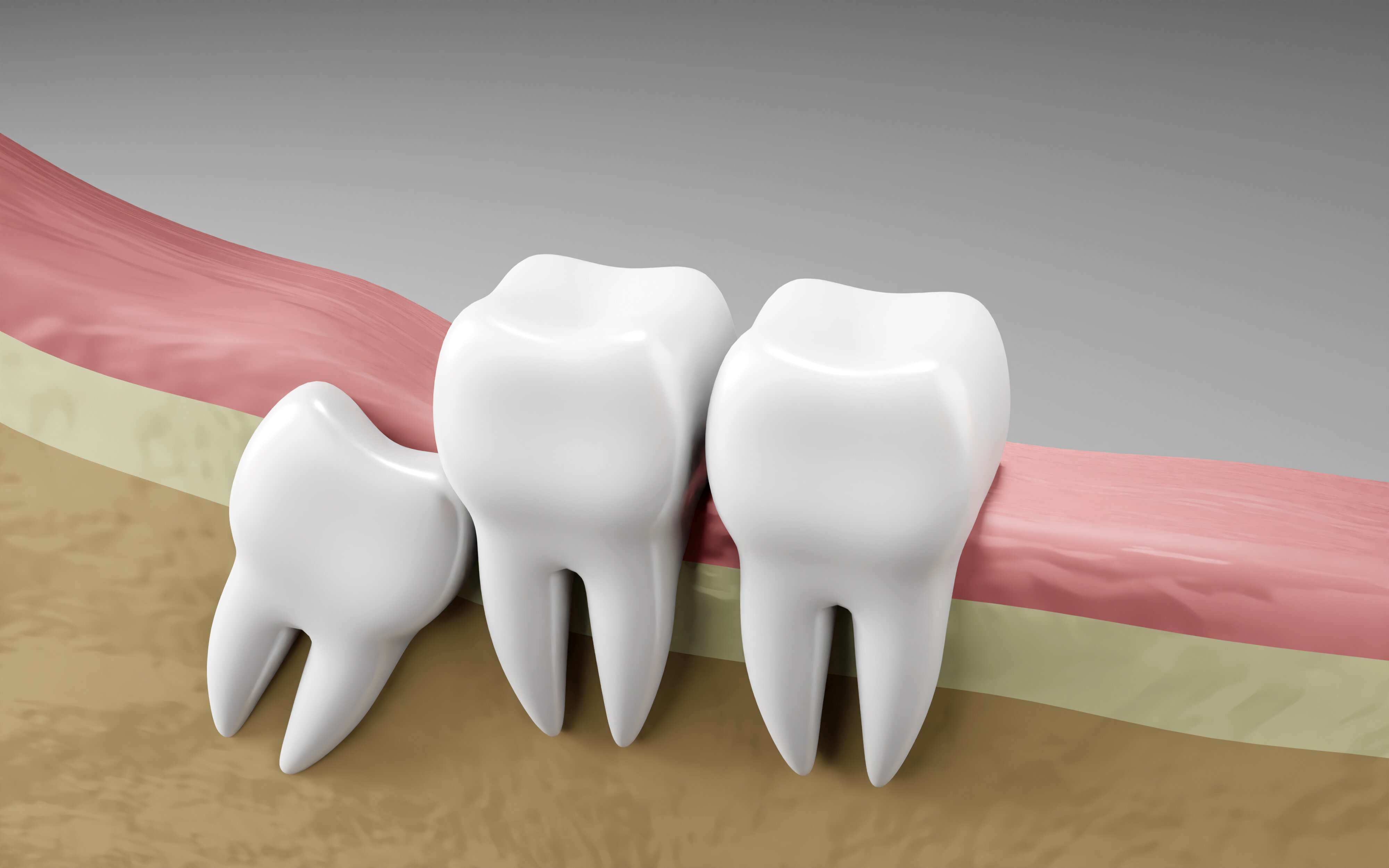 wisdom_tooth_impaction_oral_health_dental_inspection_teeth_medical_dentist-_1_-_1_.jpg