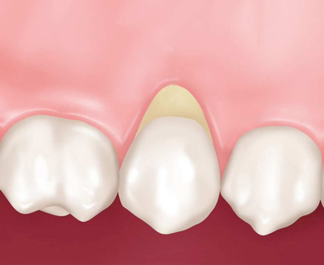 Клиновидный дефект зубов: симптомы, причины, лечение