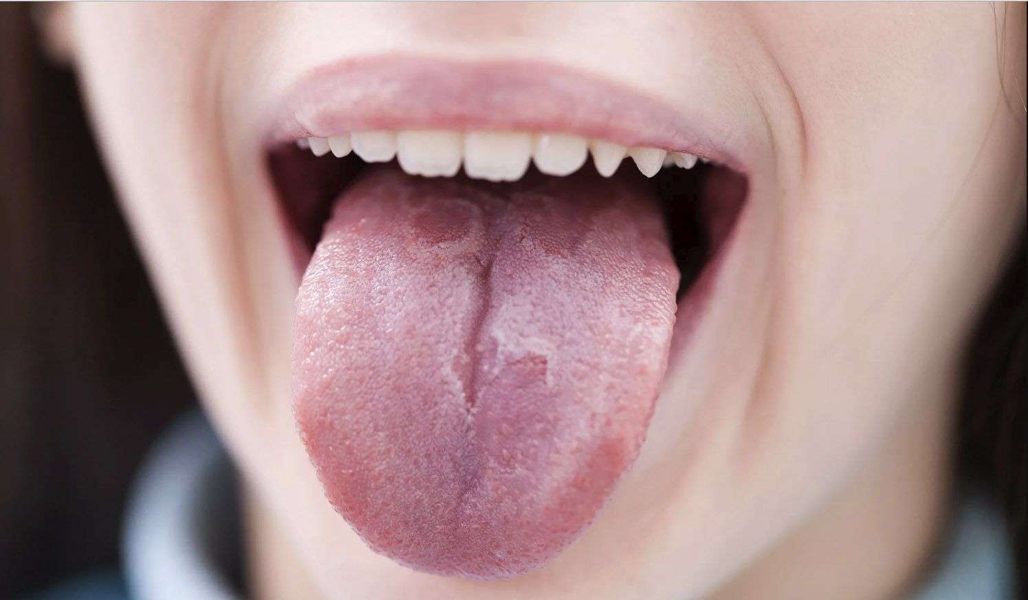 Что такое шишка во рту?
