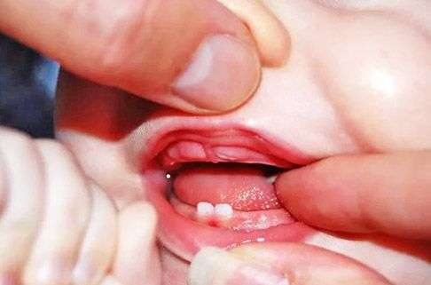 prorezivanie zubov 02