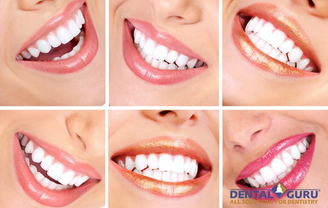 Как происходит процедура восстановления зубов?