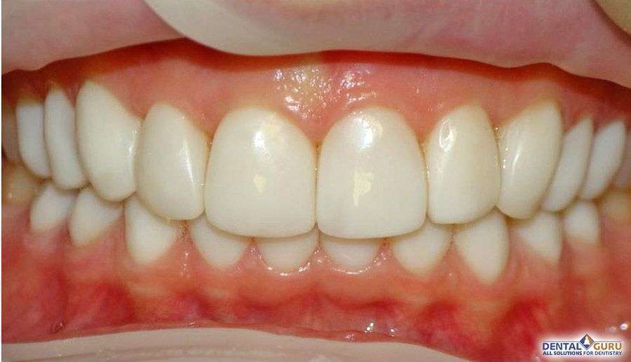 Отбеливание зубов 2-2