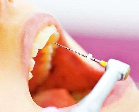 процедуры лечения зубных каналов 