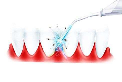 Применение ирригатора полости рта