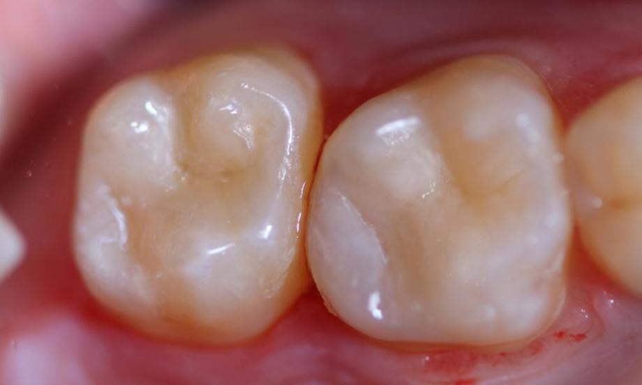 Лечение глубокого кариеса жевательных зубов