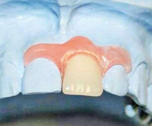 временные протезы на передние зубы