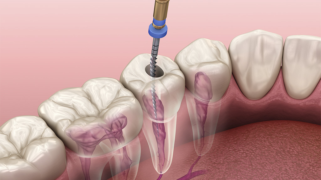Почему же зуб с удаленным нервом может болеть?