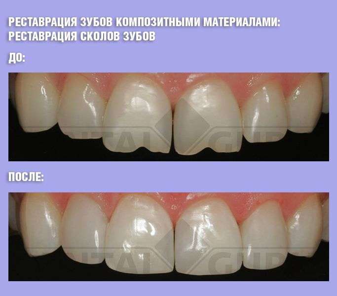 Цена композитной реставрации. Композиты для передних зубов. Восстановление зубов композитными материалами. Восстановление передних зубов. Реставрация передних зубов композитным материалом.