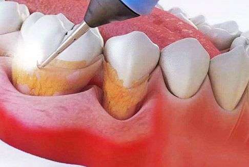 процесс удаления зубного камня