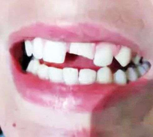 скол зуба