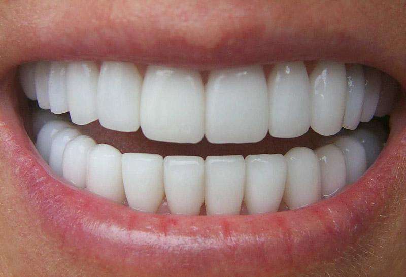 Циркониевые коронки на зубах