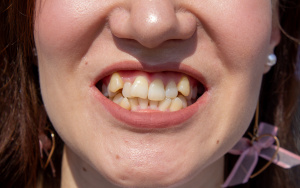 Кривые зубы портят не только внешность