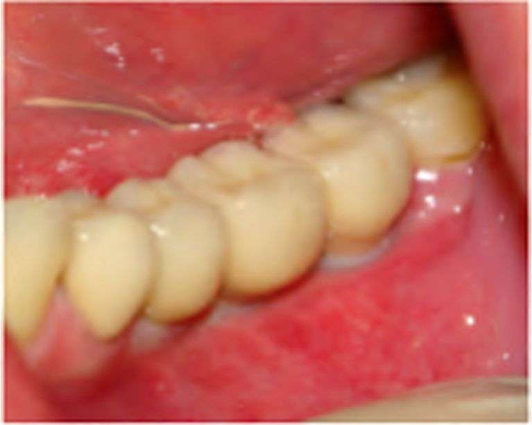 До и после имплантации зубов под ключ: