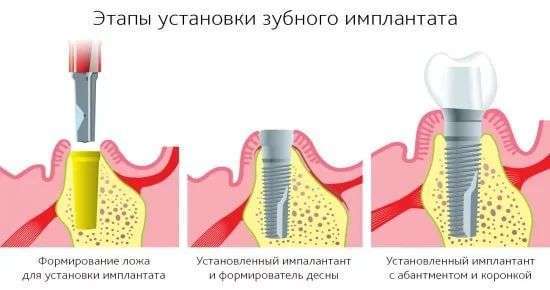 этапы установки импланта