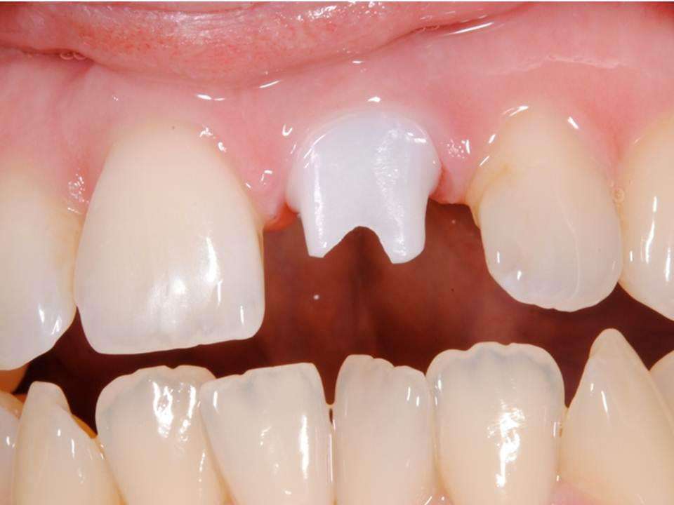 импланты зубные