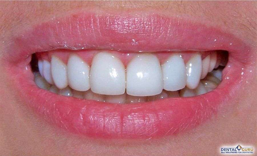 композитное отбеливание зубов 1-2