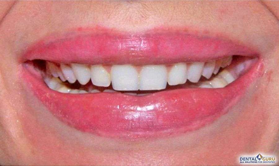 композитное отбеливание зубов 1-3