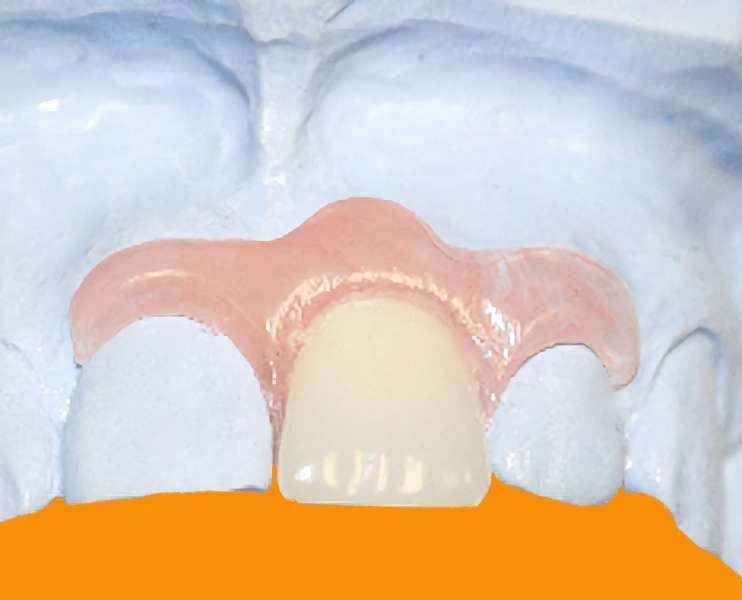 Имплантация передних зубов - Иммедиат протез бабочка