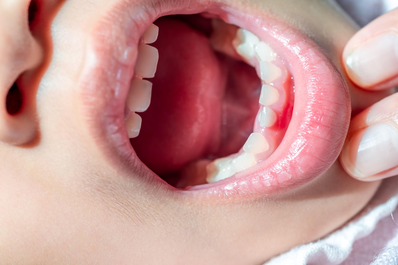 Заживление лунки зуба после удаления
