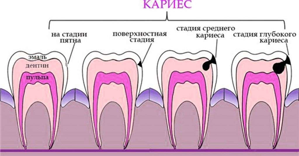 причины появления кариеса в зубах
