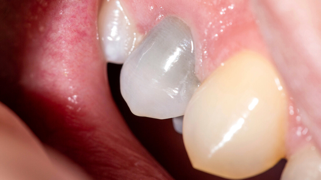 Потемнели зубы: возможные причины и способы отбеливания