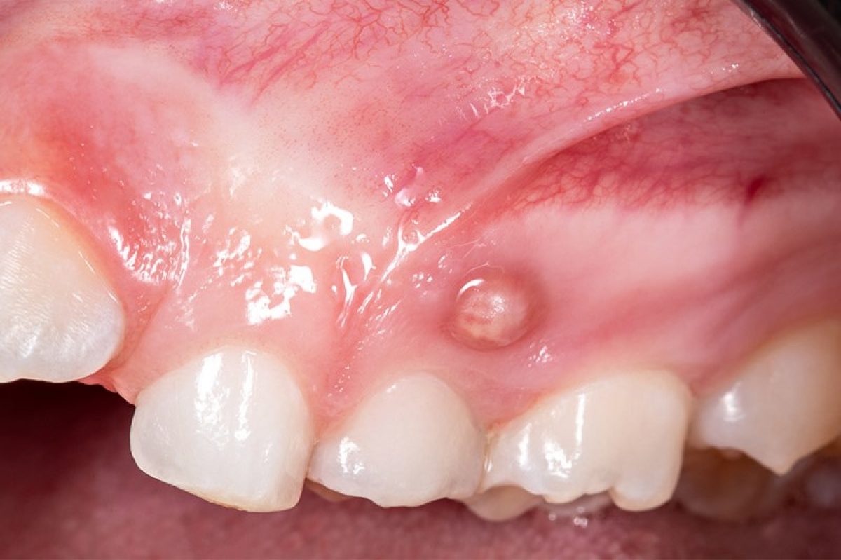 granuloma-dentale-gengive-denti-1-1200x799.jpeg
