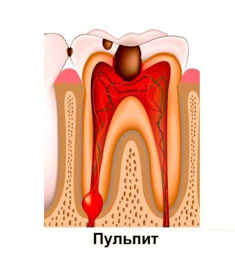 причины воспаления зубного нерва