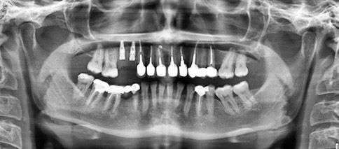 снимок рентгена зубов