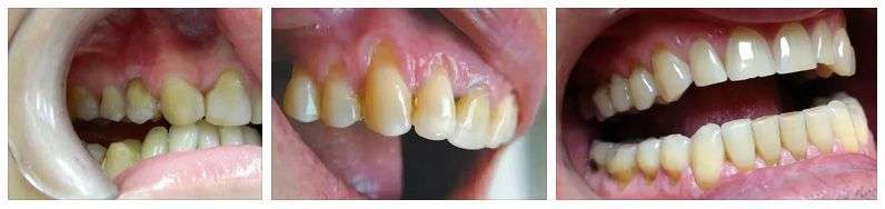 примеры клиновидных дефектов у зубов
