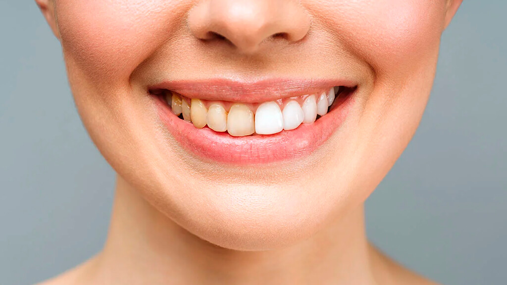 Изменение цвета зубов: пожелтел или потемнел зуб, что делать