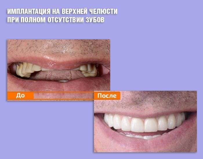 Имплантация на верхней челюсти при полном отсутствии зубов