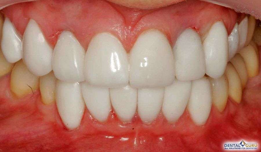 Отбеливание зубов 2-4
